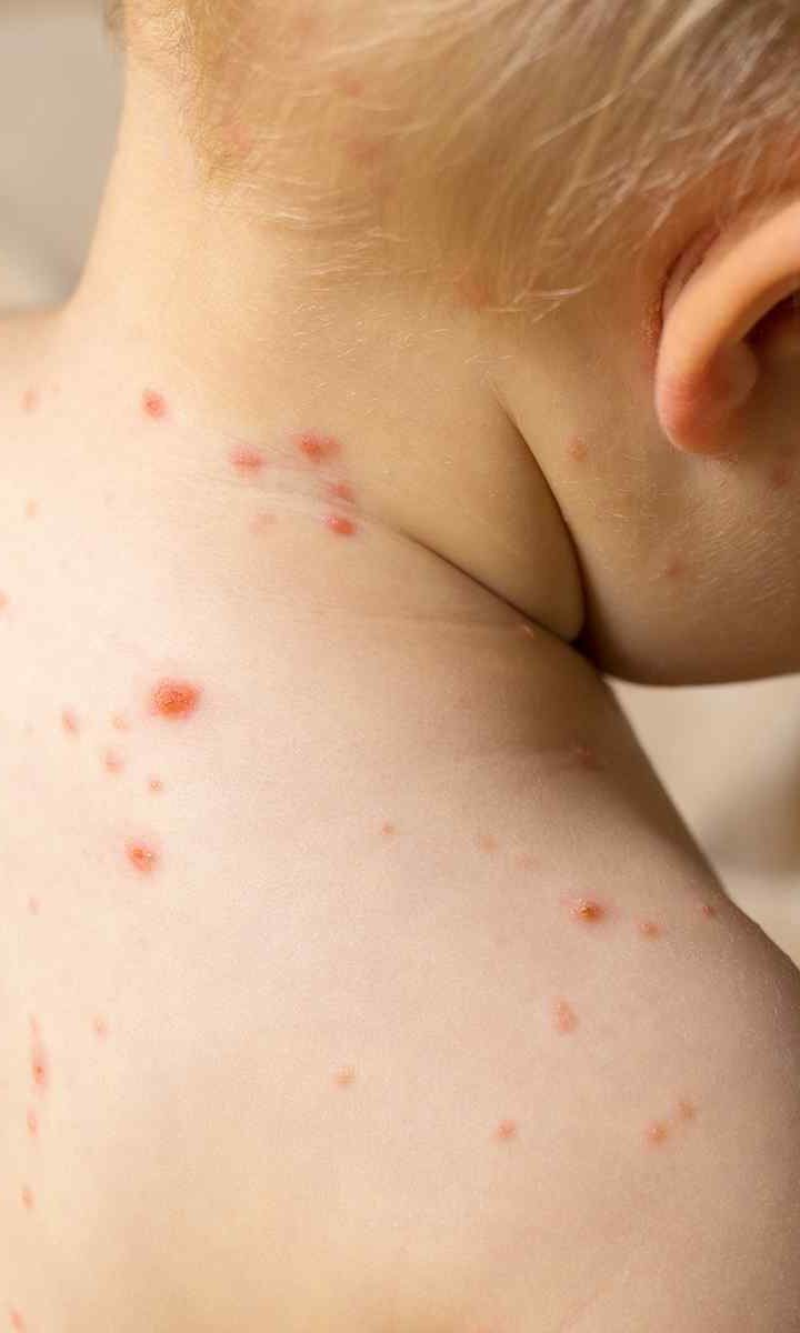 Everything You Need to Know About Measles